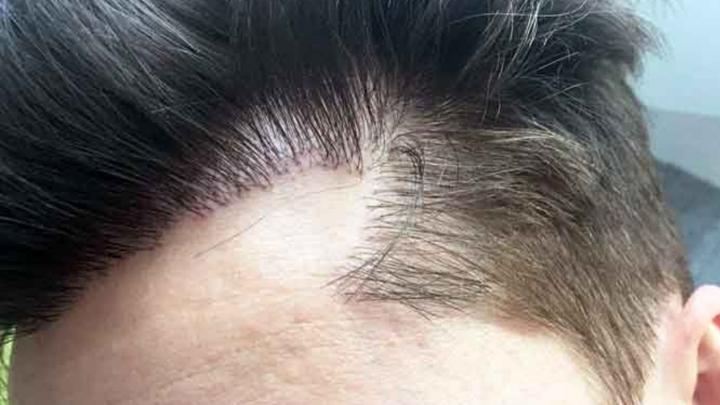 How a Hair Transplant Can Restore Your Confidence