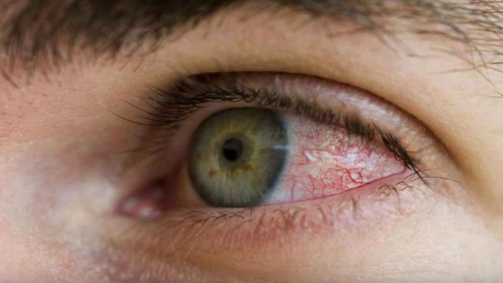 Why is Weed Making your Eyes Red?