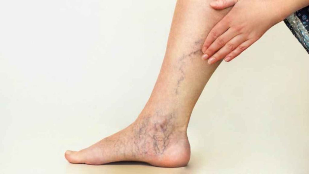 Varicose Veins and Gender Understanding the Difference in Risk and Occurrence